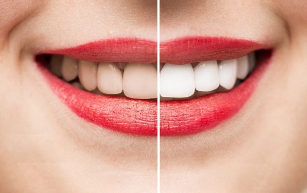Tẩy Trắng Răng: Sự Lựa Chọn Sáng Tạo Cho Nụ Cười Tươi Sáng