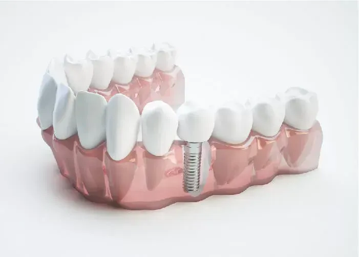 Cấy ghép Implant là gì? Có nên cấy implant không?