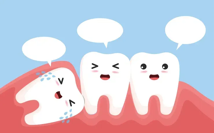 Nhổ răng khôn an toàn tại Việt Mỹ