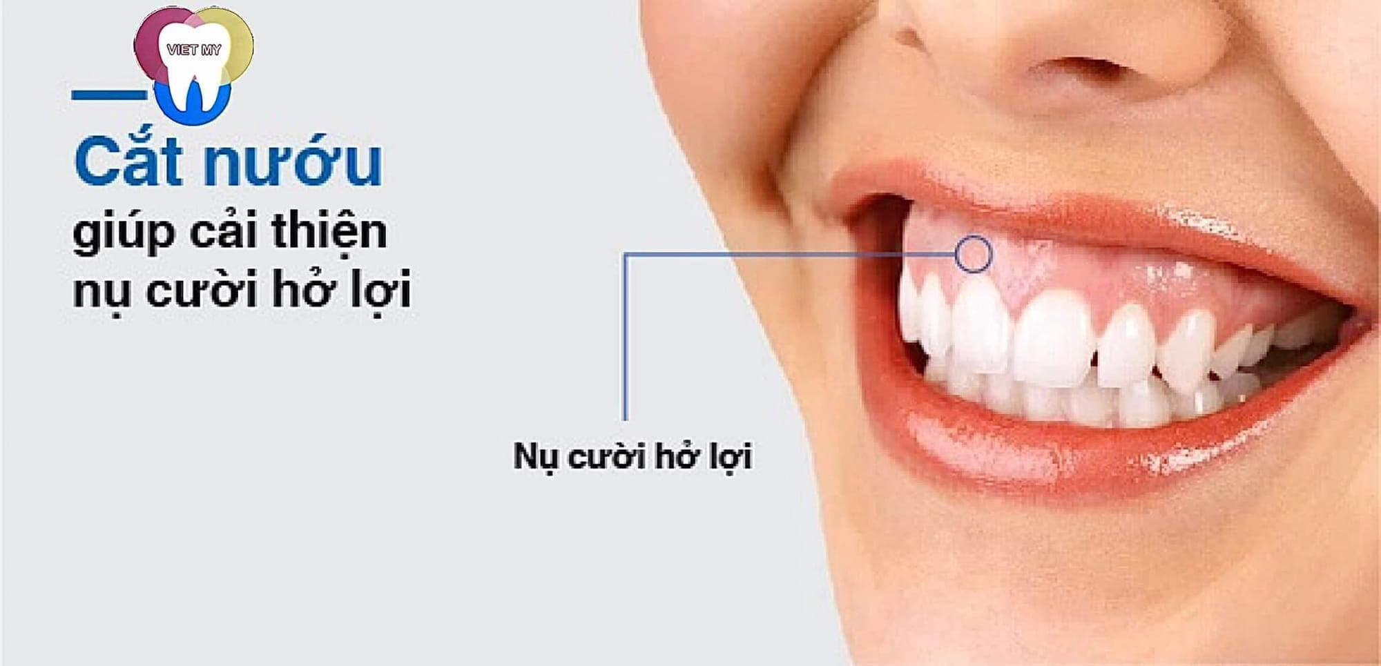 Cắt Nướu Có Ảnh Hưởng Đến Răng không ?