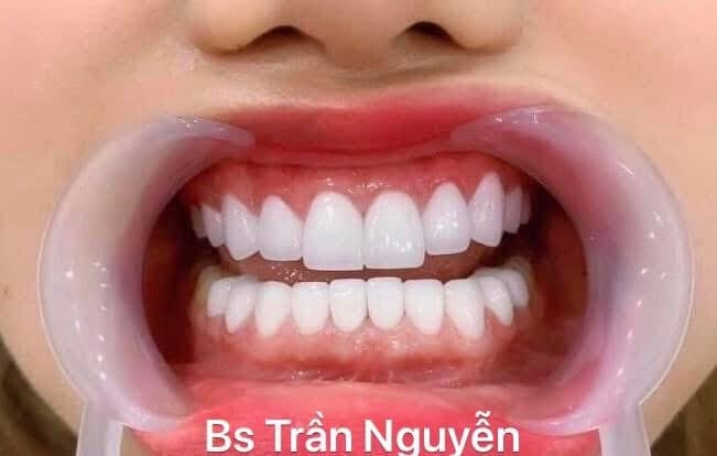 Răng sứ phong thủy – Tài lộc thay đổi vận mệnh