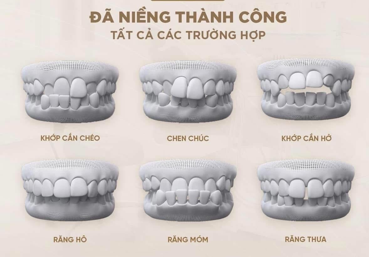 “Niềng Răng Cho Con - Để Con  Nhanh Chạm Tới Ước Mơ “