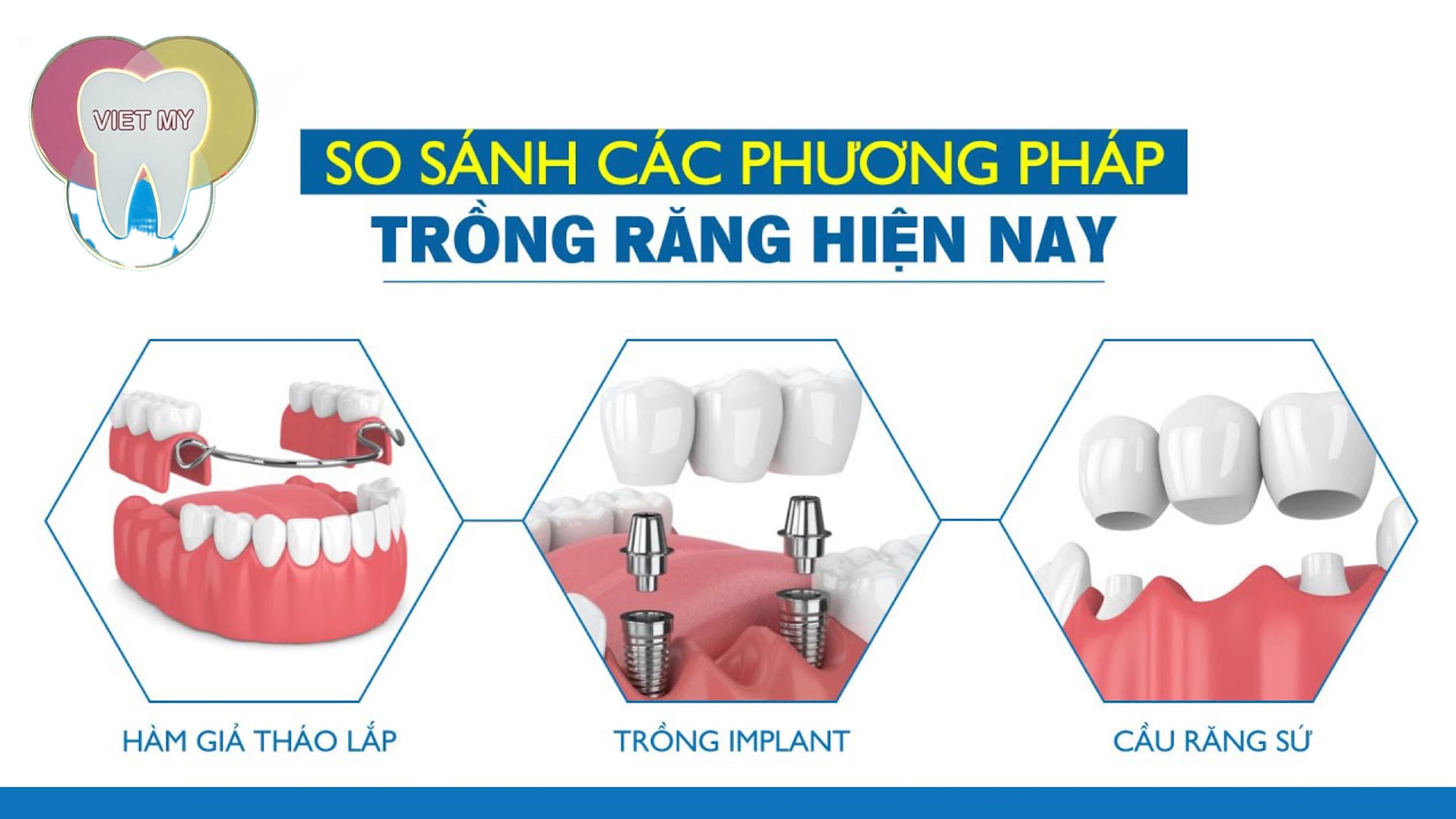 HÀM THÁO LẮP, CẦU RĂNG SỨ HAY TRỒNG RĂNG IMPLANT- Ưu điểm và hạn chế của 3 phương pháp điều trị cho người mất răng